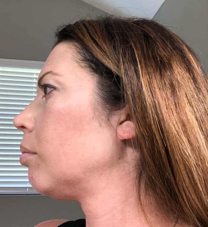 side view after picture of woman in her late 30s after a vampire facial