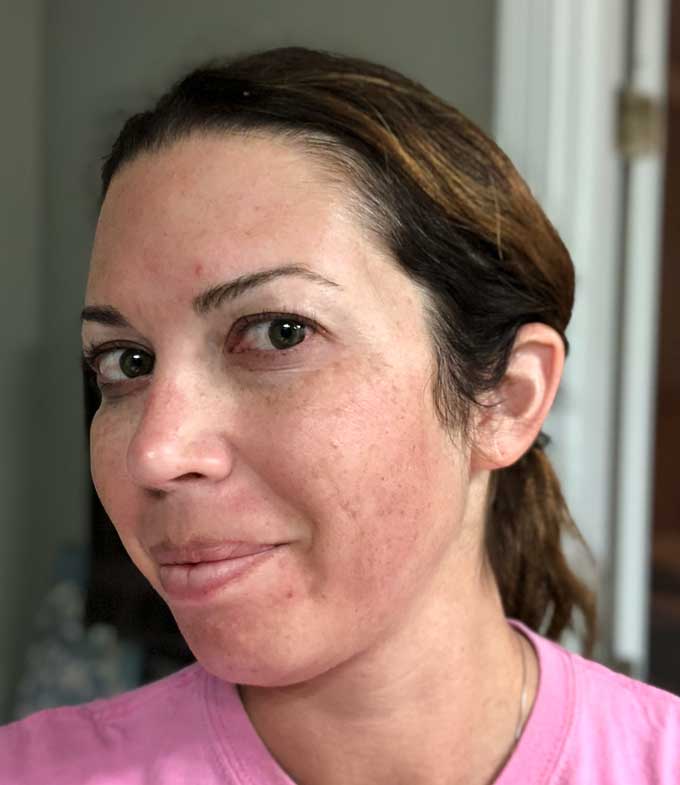 redness on face after vampire facial