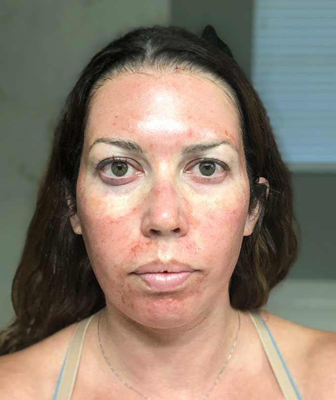 inflamed face prp facial