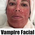 red face after prp vampire facial