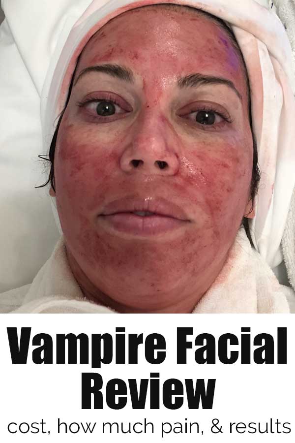 red face after prp vampire facial